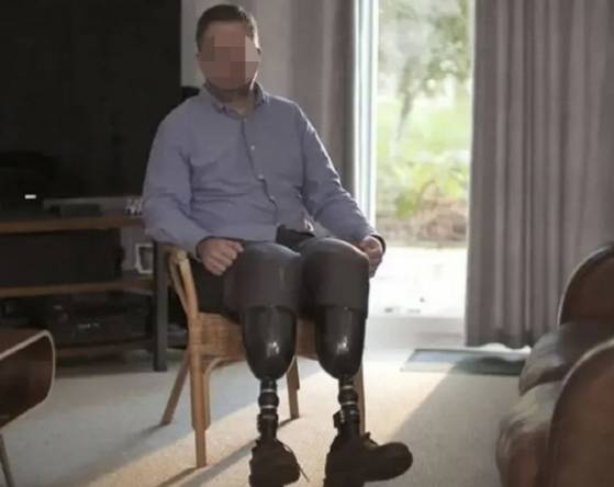 고의로 자신의 다리를 절단한 영국 외과의사 닐 호퍼. 사진 BBC 캡처