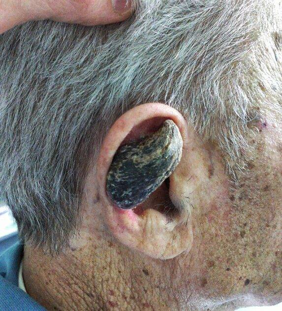 피부각(cutaneous horn)의 전형적인 형태.  피부 표면에 각질이 비정상적으로 축적되면서 뿔처럼 자라는 것이 특징이다. [사진=위키피디아]