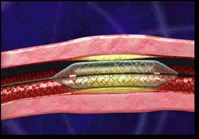 혈관 속에 스텐트가 삽입된 상태를 그린 모식도. 한국일보 자료사진