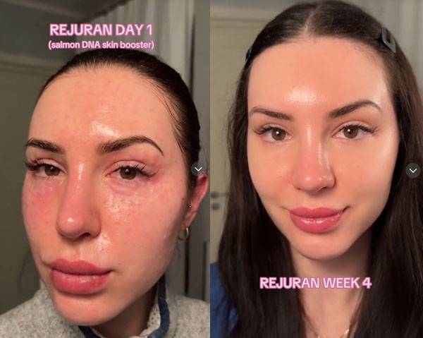 틱톡 크리에이터 올가 쉬르머 박사는 리쥬란 시술 전후 과정을 영상으로 공유해 화제를 모았다./사진=틱톡 '@dr.schirmer' 캡처