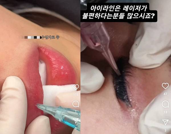 앰플과 바늘을 이용한 문신 제거 시술/사진=소셜미디어 갈무리