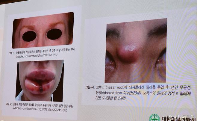 대한피부과학회가 11일 개최한 기자간담회에서 일반의가 시술한 후 나타난 부작용 사례를 공개했다. 눈물도랑·입술에 필러를 잘못 주입해 퉁퉁 붓거나, 코뿌리에 돼지콜라겐 필러를 주입한 후 무균성 농양이 생긴 사례들이 언급됐다. /사진=정심교 기자