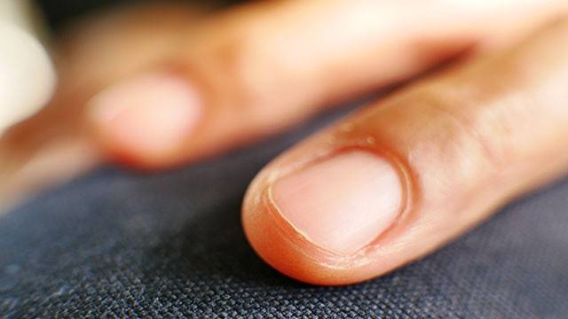 손에 있는 거스러미를 잘못 뜯으면 질환으로 이어질 수 있다|출처: 게티이미지뱅크