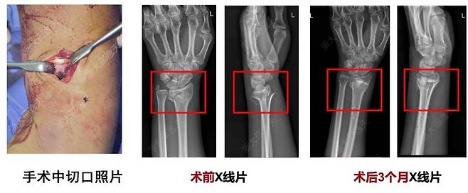 요골 원위부 골절 '본-02' 치료 사례 / 연구팀 제공 사진