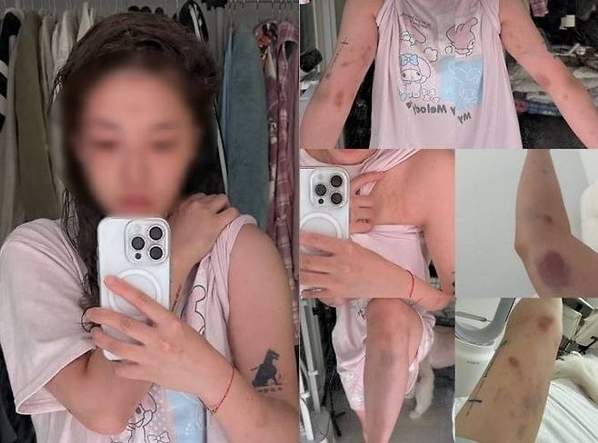 지난 15일 오전 5시 20분쯤 홍대 인근에서 중국 국적의 20대 남성 A씨가 대만 국적 여성 유튜버 B씨 등 2명을 폭행한 사건이 벌어졌다. 사진은 폭행당한 유튜버가 공개한 상처 모습. /인스타그램