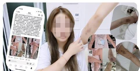 폭행당해 멍든 신체를 공개하는 대만 유튜버 [유튜브 캡처. 재판매 및 DB 금지]