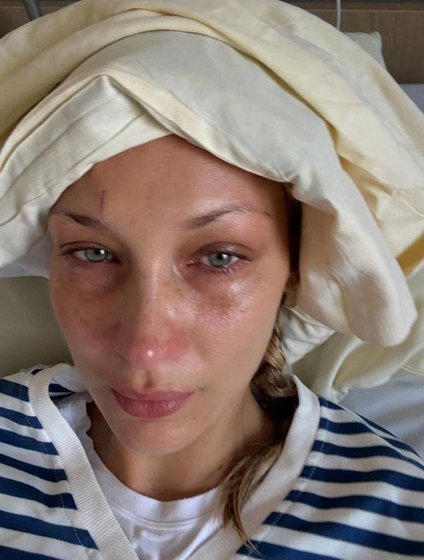 미국 모델 벨라 하디드(28)가 라임병 투병 근황을 전했다.​/사진=벨라 하디드 인스타그램 캡처