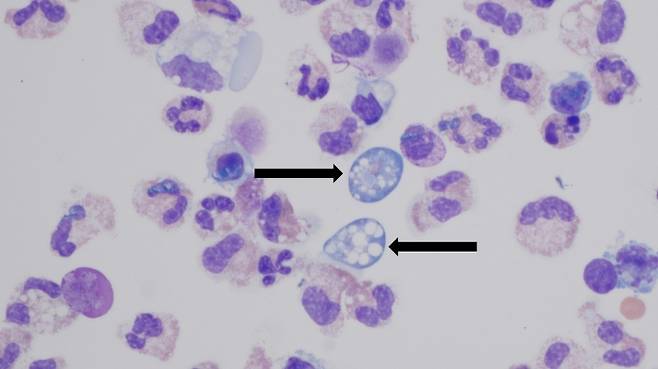 아메바성 뇌수막염을 일으키는 네글레리아 파울러리(화살표로 표시). 미 질병통제예방센터(CDC) 홈페이지 캡처
