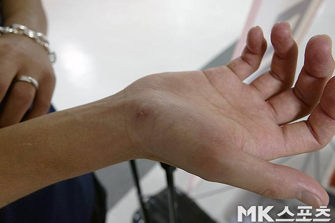 김건희의 오른쪽 손목. 김건희는 현재 엄지손가락 쪽 손목에 있는 작은 뼈인 ‘주상골’에 나사를 박아둔 상태다. 사진=이근승 기자