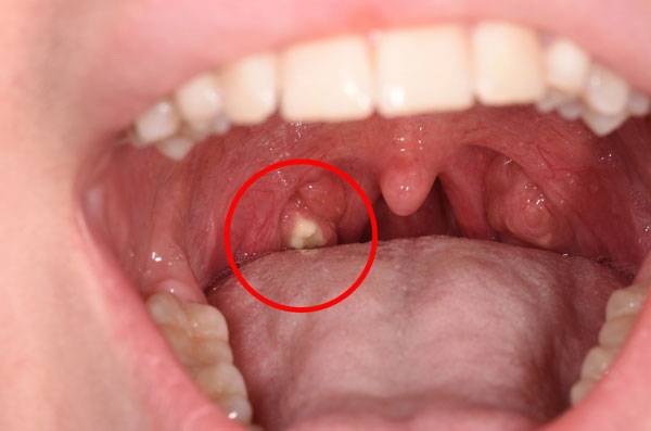 빨간 원 안의 노란 알갱이가 편도결석./클립아트코리아