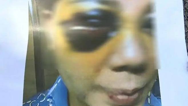 중국에서 성형수술을 받은 한 여성이 부작용으로 변한 얼굴을 공개했다. 중국 매체 환구망 캡처