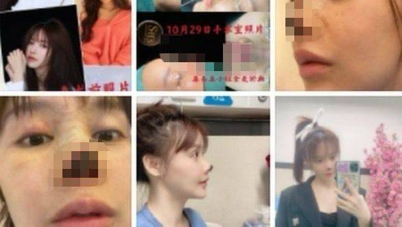 중국 여배우 가오류는 지난 2020년 코 성형수술을 받은 직후부터 심각한 부작용에 시달리고 있다. 가오류 웨이보 캡처