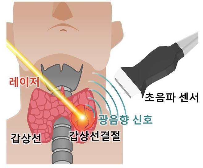 국내 연구진이 빛과 초음파를 결합해 조직검사 없이 갑상선암을 더 정확하게 판별하는 새로운 영상 시스템을 개발했다./포스텍