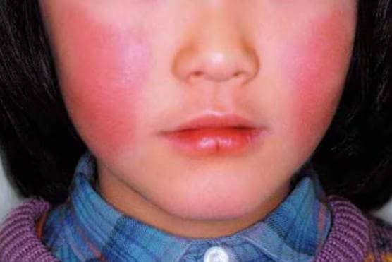 '사과병'이라 불리는 감염성 홍반으로 인해 양쪽 뺨에 붉은 발진이 나타난 모습. 사진 오키나와TV 캡처
