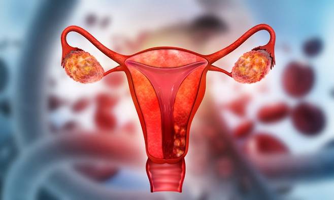 자궁을 표현한 이미지. 게티이미지뱅크 제공