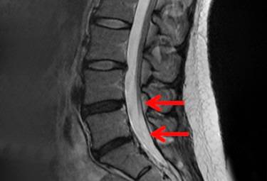 ▲ 변성 디스크_블랙 디스크
