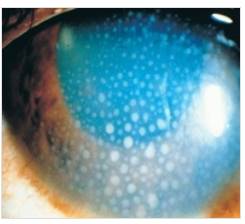 포도막염을 확대한 사진. /자료=서울아산병원 건강정보