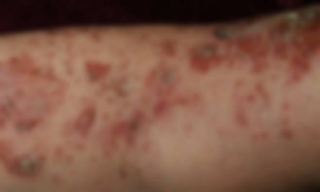 대상포진 환자의 피부발진. 서울아산병원 제공