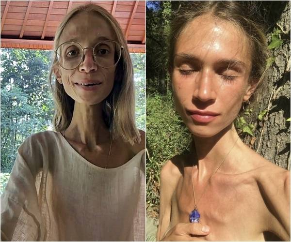 폴란드 출신인 카롤리나 크시자크(27)는 생과일만 섭취하는 극단적인 식단인 ‘과일주의(fruitarian)’를 고수하다 결국 숨졌다. 사망 당시 체중은 약 22㎏에 불과했다. 카롤리나 크시자크 인스타그램(@carolina.mariie) 캡처