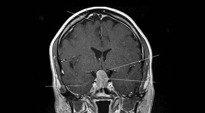 2007년 56세에 찍었던 대니얼 깁스의 뇌 사진. 노화로 인한 경미한 뇌 위축과 함께 가운데 아래 하얗게 뇌하수체 종양이 보인다.