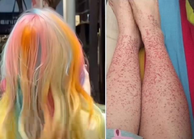 K팝 아이돌을 따라 염색한 20대 여성이 신장 질환을 앓게 됐다. SCMP 캡처