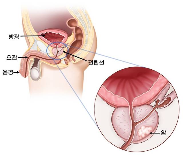 비뇨기 구조와 전립샘암 호발 부위. 자료 서울아산병원