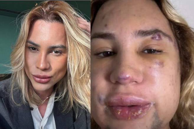 '여우 눈' 시술을 받고 부작용으로 사망한 패션 스타일리스트 '아데이르 멘데스 두트라 주니어'. 출처=SNS, 데일리메일