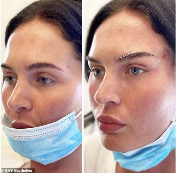 '여우 눈' 시술 전 후 모습. 출처=데일리메일