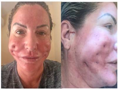 실리프팅 부작용으로 얼굴에 생긴 구멍 [더 선]