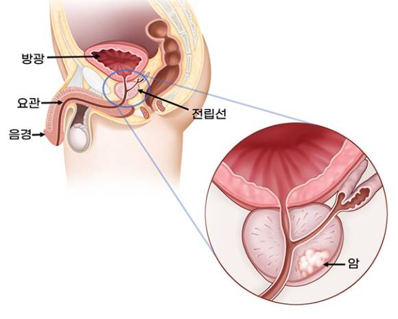 전립선 암은 세계적으로도 흔한 질환이며 현재 한국도 증가 추세다. 사진은 전립선 암에 대한 설명도. [사진=서울아산병원]