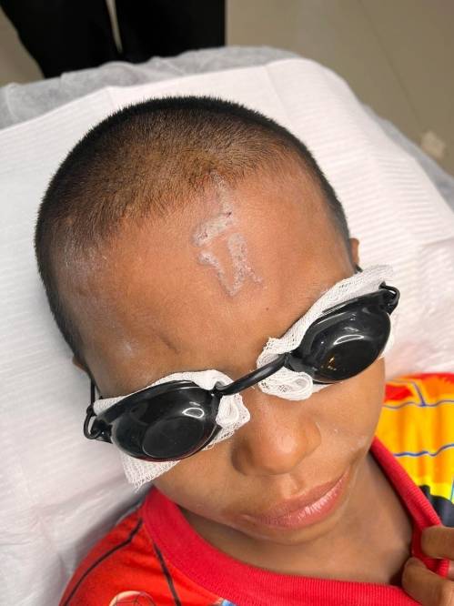 태국의 10살 소년 카오가 동급생들이 급조한 문신 기구를 사용해 새긴 이마 문신을 제거하는 시술을 받는 모습. 페이스북 캡처