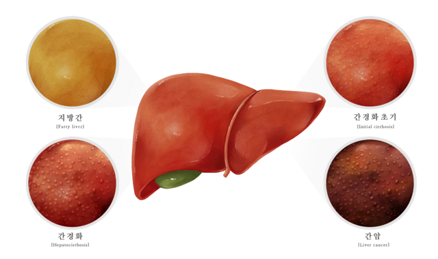 대표적인 간 질환들. 클립아트코리아