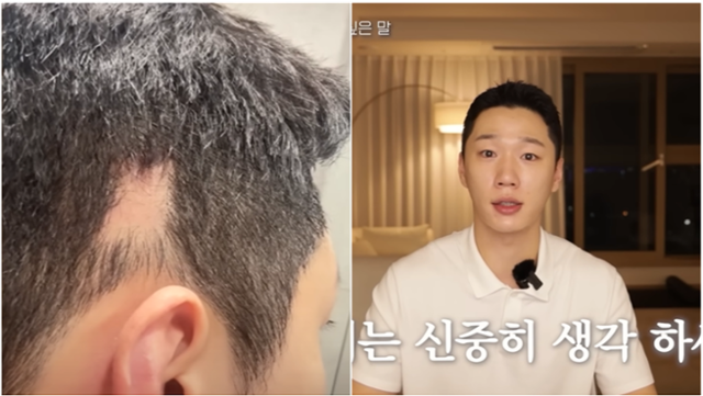 남성 뷰티 유튜버 '준돌'이 12일 자신의 유튜브 채널을 통해 귀 필러를 맞고 탈모 부작용을 겪은 피해 사례를 전했다. 준돌 유튜브 캡처