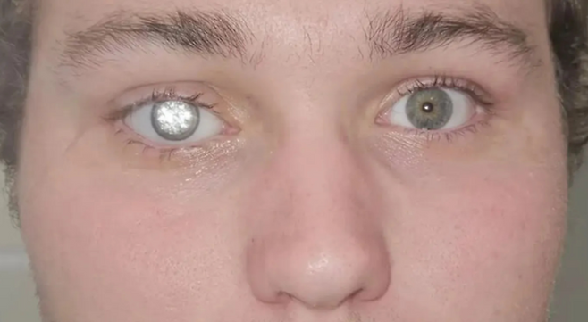 다이아몬드 의안을 낀 미국 남성 슬레이터 존스(23). 사진=인스타그램(artificialeyesbyjohnimm) 캡처