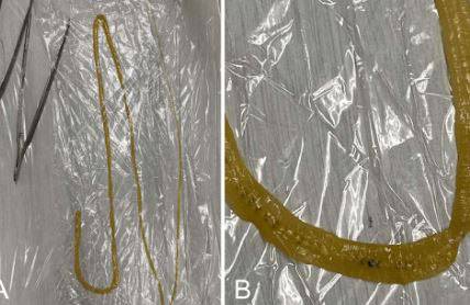 마트에서 파는 초밥을 먹은 후 항문에서 기생충이 발견된 10대 남아의 사례가 보고됐다. 오른쪽은 기생충 확대 모습./사진=큐레우스