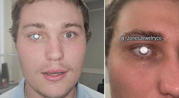 미국의 한 20대 남성이 약 29억 원 상당의 다이아몬드를 인공 눈(의안)에 삽입해 화제를 모으고 있다./사진=데일리메일