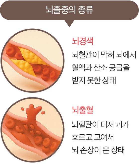 뇌졸중의 종류