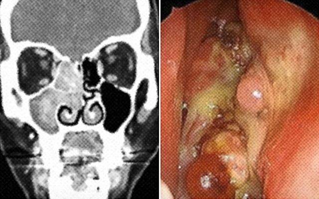 tumor photo. Seoul asan Medical Center