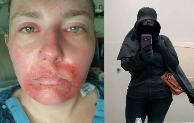 에밀리 리처드슨(36)은 하루하루를 마치 '뱀파이어'처럼 살아간다.  햇빛에 단 30초만 노출돼도 피부가 타들어가며 화상을 입는 극심한 광과민성 반응 때문이다. 사진=고펀드미