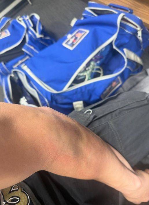 [서울=뉴시스] 월드시리즈 당시 엔리케 에르난데스의 팔꿈치 상태. (사진 = 엔리케 에르난데스 인스타그램 캡처) *재판매 및 DB 금지