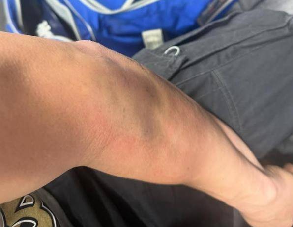 월드시리즈 당시 에르난데스의 팔꿈치 상태 [에르난데스 소셜 미디어 캡처. 재배포 및 DB 금지]