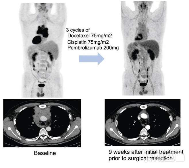 수술에 앞서 3주 간격으로 세 차례 항암화학요법에 면역항암제 펨브롤리주맙을 병용 투여한 결과병리학적으로 완전 관해를 보인 환자 예시. 이 환자는 3기 흉선암이었으나 현재 3년 이상 재발 없이 경과 관찰 중이다. (사진= 세브란스 병원 제공)