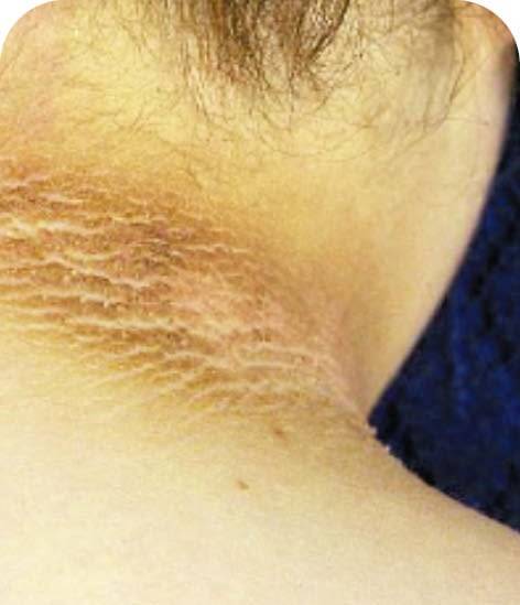 당뇨와 다낭성 난소 증후군목 뒤 등 갈색으로 변화