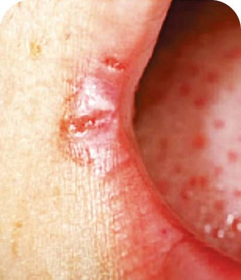 철분·비타민B 부족과 아토피입술 끝이 갈라지는 구각염