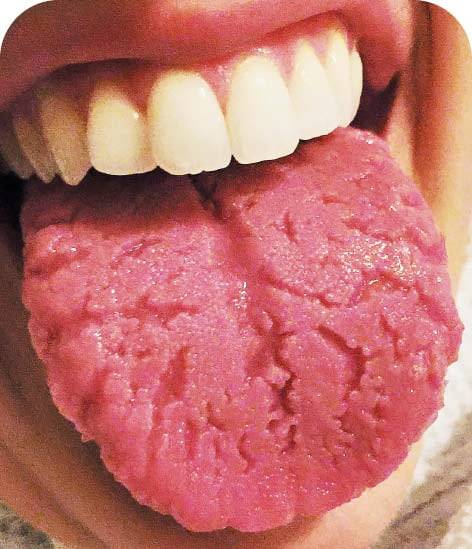 대사증후군과 구강 건조증혀 표면에 파이는 깊은 주름