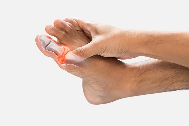 통풍은 관절에 날카로운 결정이 쌓여 붓고 심한 통증을 유발하는 관절염의 한 형태이다. 사진= 게티이미지뱅크