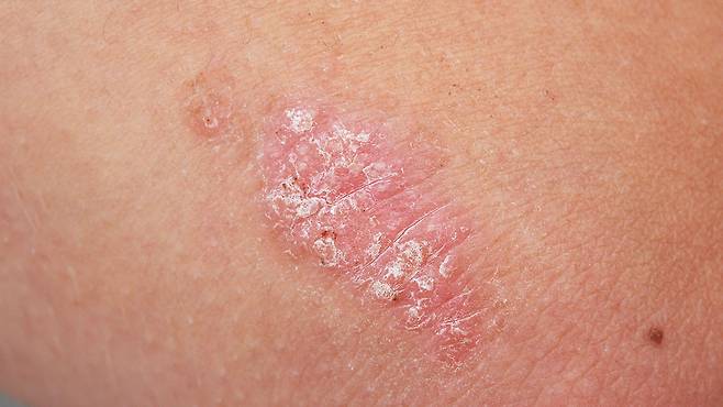 건선은 전염되지 않는다｜출처: 클립아트코리아