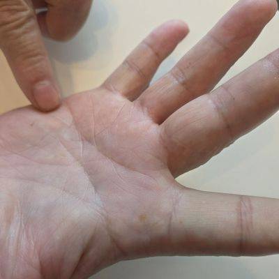 신안 염전 노동착취 피해자가 손에 흉터를 가리키며 염전주에게 당했던 폭행으로 남은 상처라고 설명하고 있다. 민찬기 기자