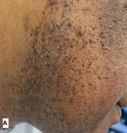 피부에 오돌토돌한 구진이 발생했다면 HPV 감염으로 발생하는 사마귀를 한 번쯤 의심해야 한다./사진=큐레우스