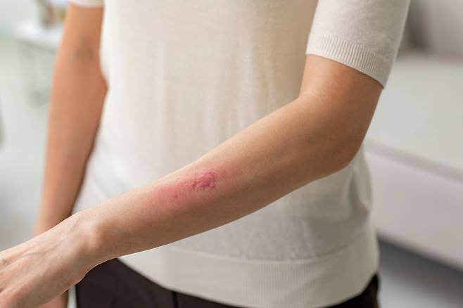 대상포진 증상이 주목된다. 사진은 기사 내용과는 무관함. /사진=클립아트코리아